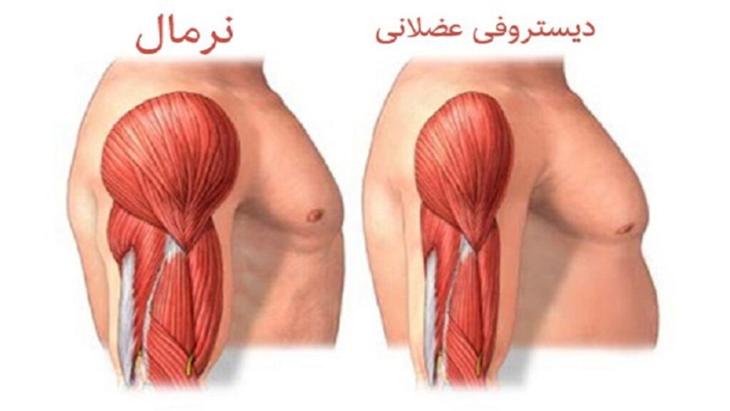 دیستروفی عضلانی