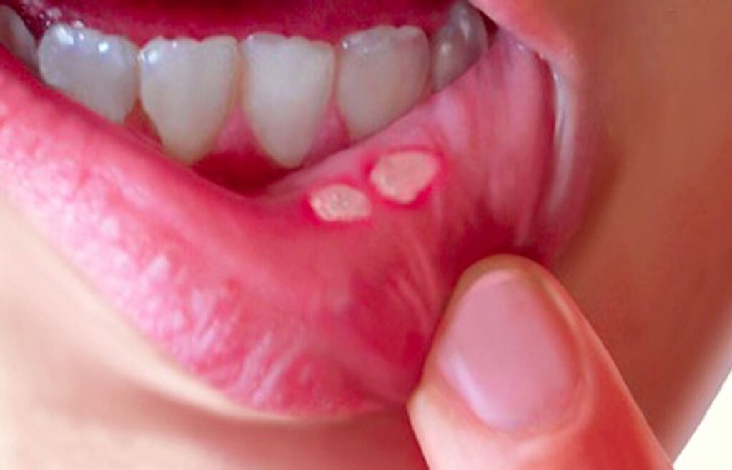 بیماری‌های دهان