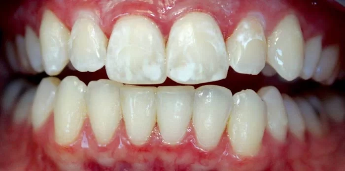  کلسیم زدایی دندان‌ها 