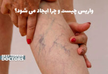 واریس چیست و چرا ایجاد می شود؟ علائم، علت ها و بهترین روش های درمان بدون جراحی