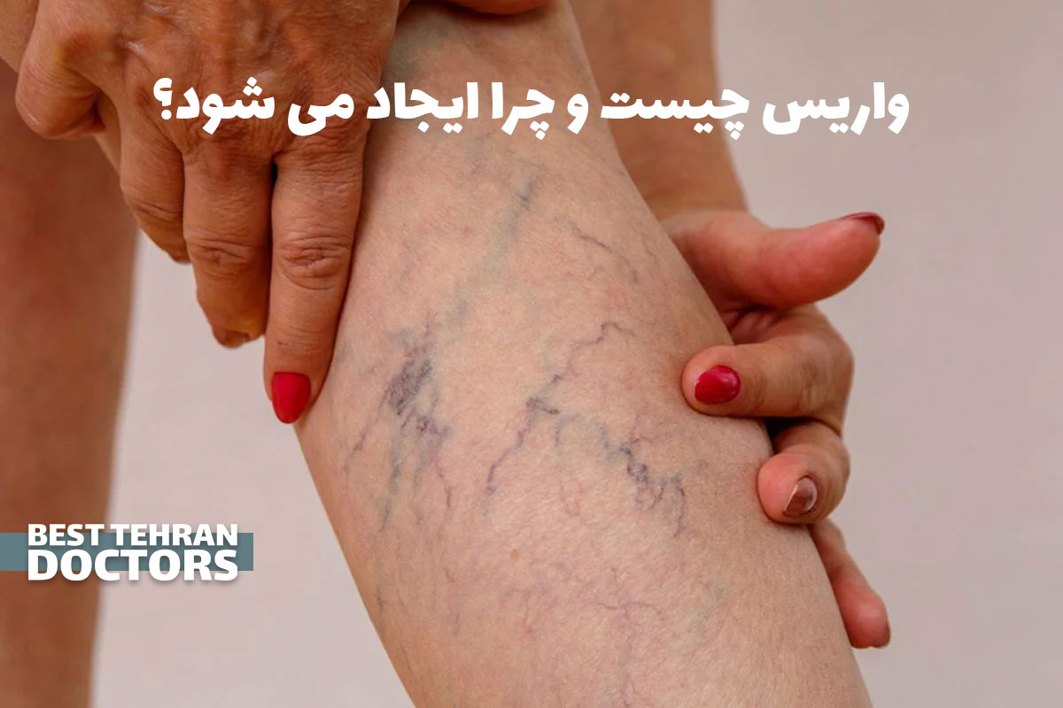 واریس چیست و چرا ایجاد می شود؟ علائم، علت ها و بهترین روش های درمان بدون جراحی