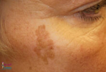 بیماری پوستی سیاه شدن پوست