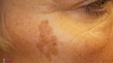 بیماری پوستی سیاه شدن پوست