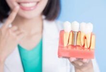 بهترین دکتر ایمپلنت دندان در تهران | معرفی 7 کلینیک + آدرس و شماره تماس