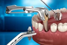 لیست بهترین متخصصان ایمپلنت فوری در تهران