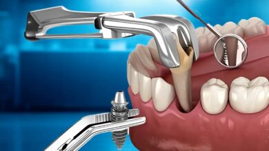 لیست بهترین متخصصان ایمپلنت فوری در تهران