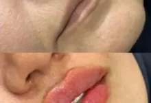 رازهای طلایی مراقبت بعد از تزریق ژل لب و صورت؛ چگونه ماندگاری فیلر را 2 برابر کنیم؟