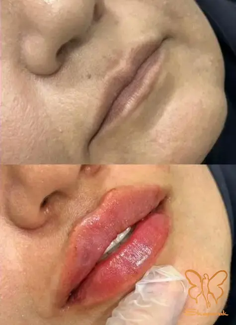 رازهای طلایی مراقبت بعد از تزریق ژل لب و صورت؛ چگونه ماندگاری فیلر را 2 برابر کنیم؟
